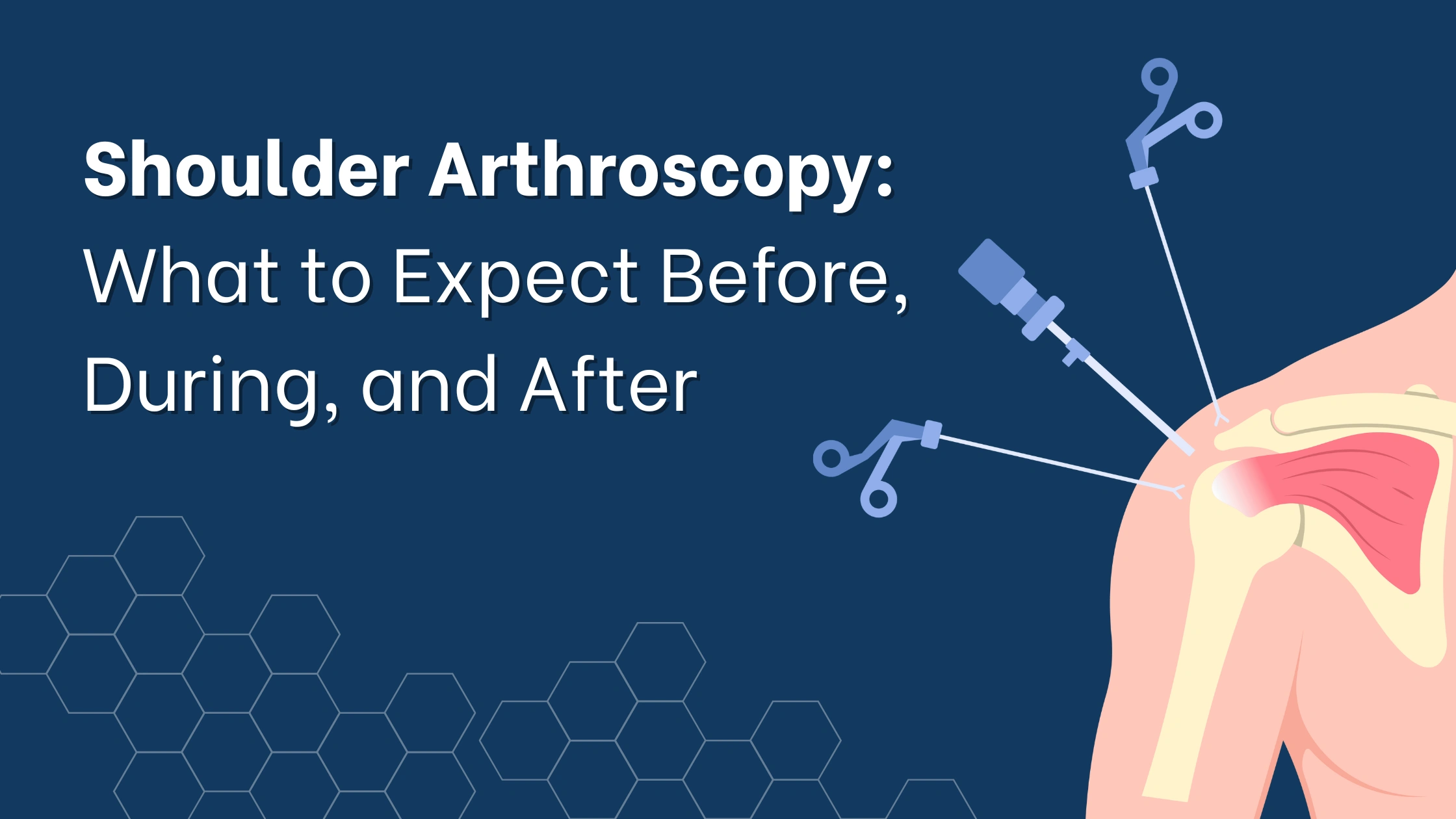 Shoulder Arthroscopy