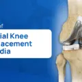 Cost of Partial Knee Replacement in India