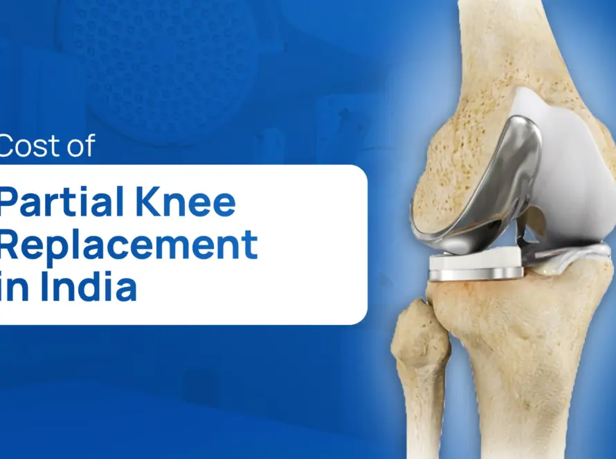Cost of Partial Knee Replacement in India