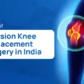 Cost of Revision Knee Replacement Surgery in India